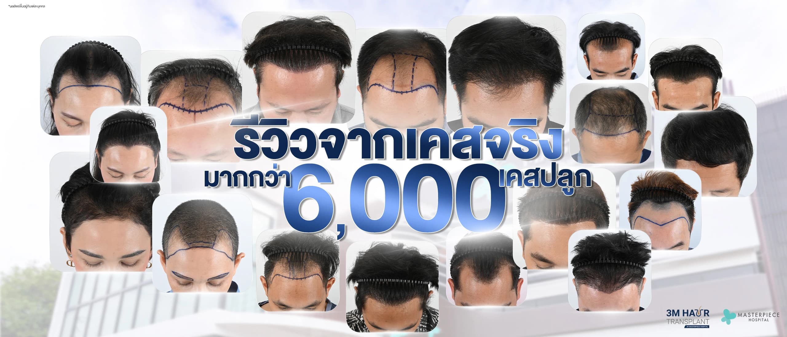3M HairTransplant